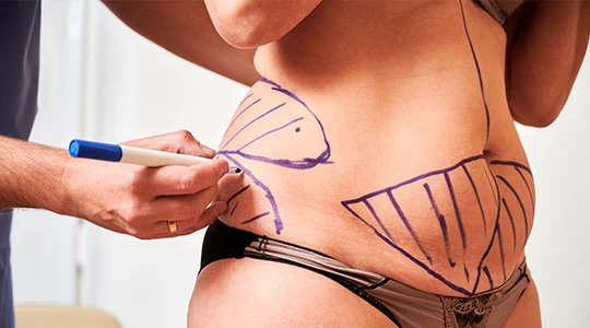 Antalya’da karın germe (abdominoplasti) için kaç gün kalınır? Gün gün seyahat planı, kontrol ve konaklama önerileri